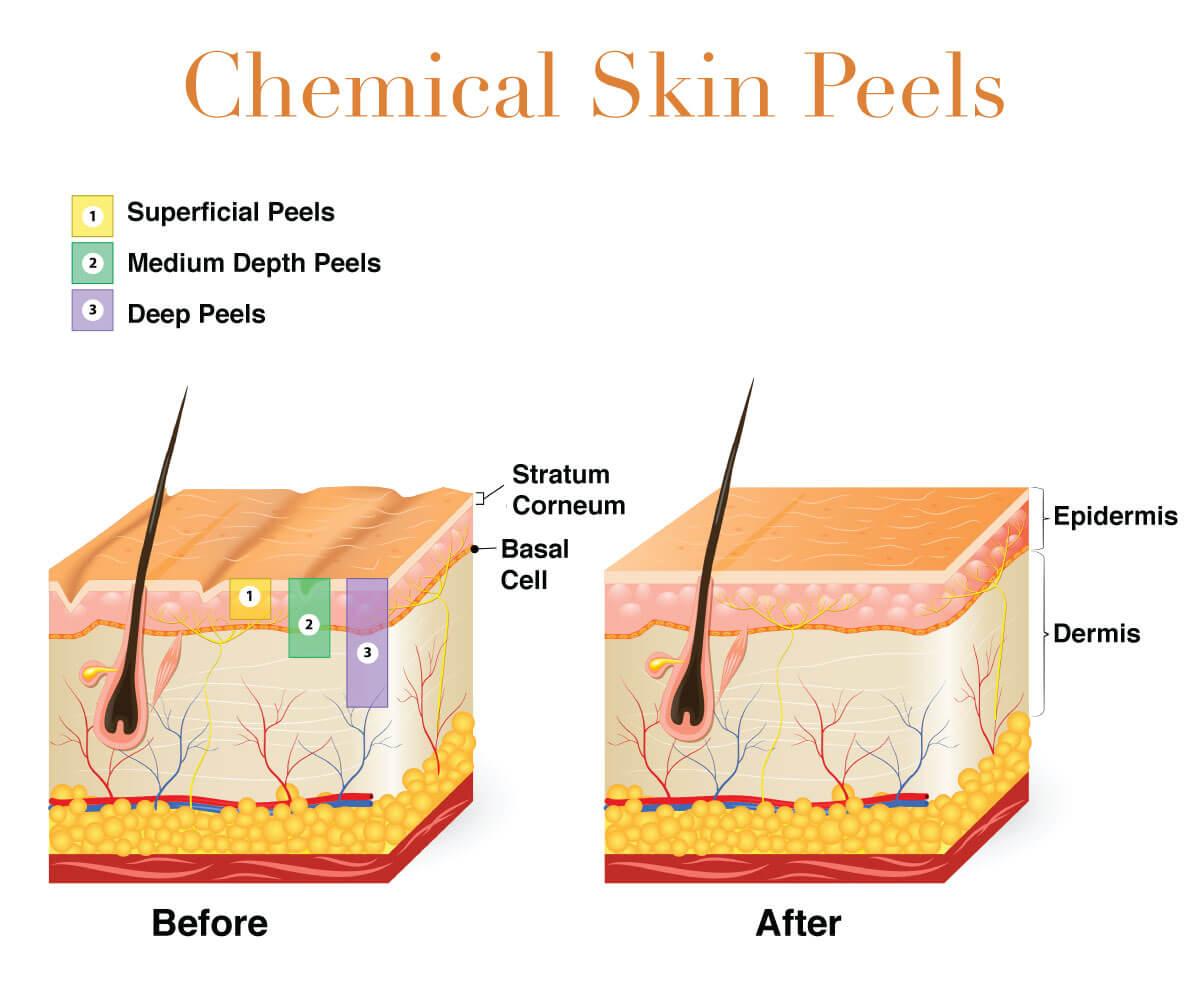 Infographic on chemical peels